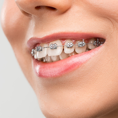 Ortodonti Tedavisi